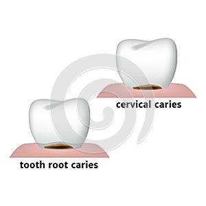 Cervical caries and root caries.